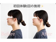 リフェイス(RE:FACE)/初回体験1回の施術