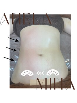 アーネラミーナ(Anela mina)/施術例 脂肪ヨウカイ注射