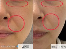 ウィ アネラ(U'i Anela)/WiQo水光ピール