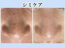 マイスタ(Myst)の雰囲気（シミ改善　シミケア６回目もし通っていなかったら今頃…）