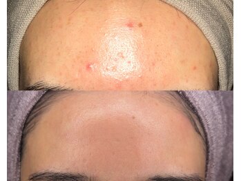 ル シーニュ/ニキビケア