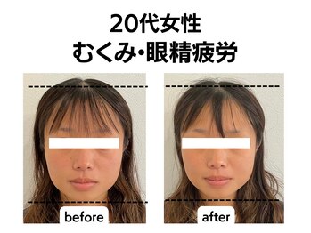 シン(SHINE)/美容鍼灸