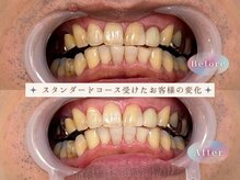モンキーホワイトニング 西千葉/男性も輝く写真映えする歯へ！