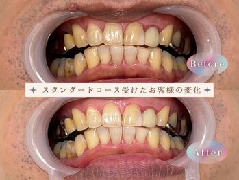 モンキーホワイトニング 西千葉/男性も輝く写真映えする歯へ！