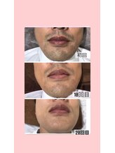 ビューティー アディクト(Beauty addict)/メンズ脱毛