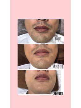 ビューティー アディクト(Beauty addict)/メンズ脱毛