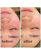 ラシック(Rachic)/クリスタルハーブパック☆