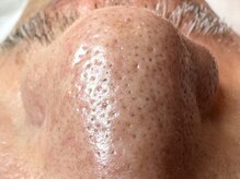 オアシスラグーン(OASIS LAGOON)/毛穴洗浄（症例１：before）