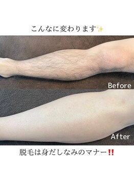 ラグズ(Ruxuce)/脚脱毛