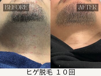 スキンジム(SKIN GYM)/剃りにくい顎裏・首筋もスッキリ