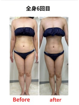 ステラ(Stella)/痩身6回目