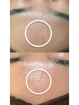 シュシュ(chouchou)/男性 韓国式艶肌フェイシャル