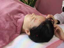 クローブ鍼灸院(CLOVE鍼灸院)の雰囲気（鼻や頭の鍼で⇒顔のむくみ◎目元ぱっちり◎頭痛にも◎美容鍼90分）