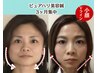 20日まで5名限定【同窓会老け見え解消】周囲が驚くリフトアップ!小顔美容鍼