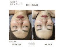 サロン エイトミー(salon 83)/【毛穴ケア＆光フェイシャル】