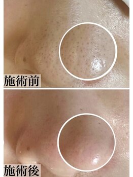 ホワイトアクア 中目黒店(WHITE AQUA)/ララピール/毛穴/中目黒