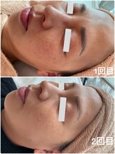 美バストアルファ(美bust α)/【シミケア】症例