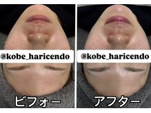 ハリシェンド/WiQOピール