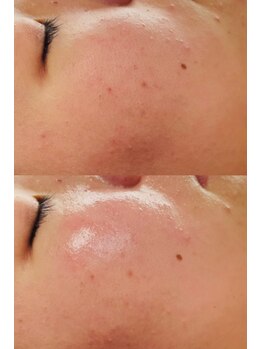 ルーク(Luke)/ビフォーアフター