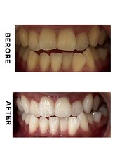 ホワイトニング ショップ 豊見城店/ホワイトニング