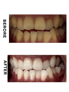 ホワイトニング ショップ 豊見城店/ホワイトニング