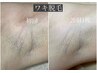 【脱毛初心者でも♪まずは脇から】　レディース両ワキ脱毛￥3,000→￥2,500