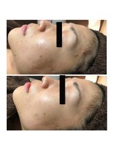 アイリス(AIRIS)/ニキビ、肌荒れにお悩みの方