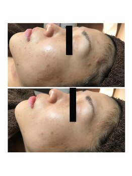 アイリス(AIRIS)/ニキビ、肌荒れにお悩みの方