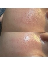 アルム(a'rme)/【毛穴コース】