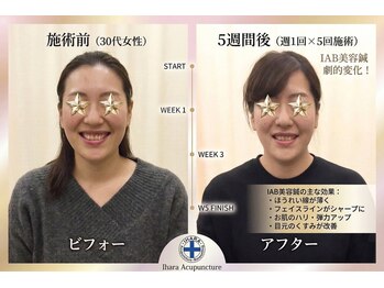 井原鍼灸整骨院/IAB美容鍼