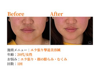 シルエラバレ(CiruelaValle)/Before After