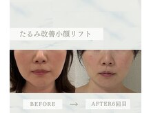 ソラ(Sola)/たるみ改善小顔リフト