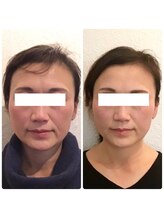 小顔全身整体　10回コース　50代　　　歪み・たるみ改善におススメ