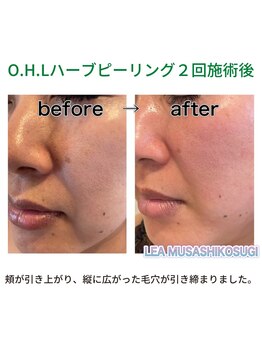 レア 武蔵小杉(LEA)/美肌ハーブピーリング：当店施術