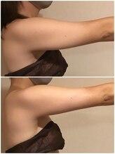 ビューティーワークスシャンティ 柏店(Beauty Works Shanti)/☆二の腕すっきり☆