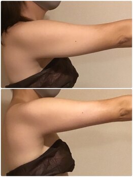 ビューティーワークスシャンティ 柏店(Beauty Works Shanti)/☆二の腕すっきり☆