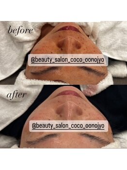 ミノア 大野城店(MINOA)/美白・シミケアハーブピーリング