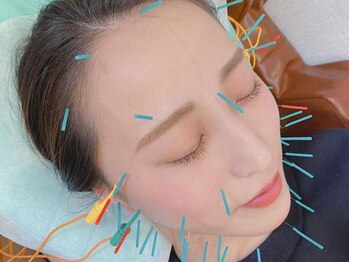 おはな整骨院 帯山院の写真/鍼に興味はあっても踏み出せなかった方必見!【OHANA美容鍼¥3980~】当院では鍼施術も通いやすい価格設定◎