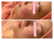 ヒメミ(Himemi)/BBL　2回目