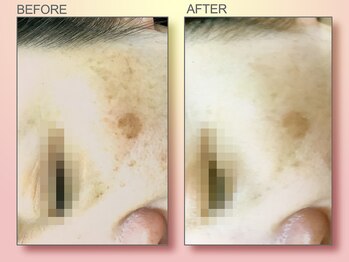 ジュリア オージェ 梅田店/ビフォーアフター（シミケアP)