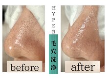 ベルスタイル(Bell style)/当店のお客様症例(毛穴ケア)