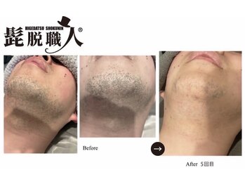 ナーズ(NAZ)/ヒゲ脱毛