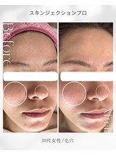 アネラ(ANERA)/スキンジェクションプロ