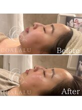 コアラル 恵比寿(COALALU)/ララピールツヤ肌韓国ピーリング
