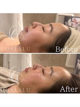 コアラル 恵比寿(COALALU)/ララピールツヤ肌韓国ピーリング