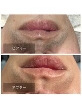 メンズ脱毛サロン レオ(REO)/ビーフォーアフター画像