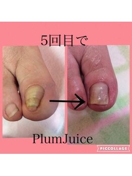 ネイルセラピーサロン プラムジュース(Nail Therapy Salon Plum Juice)/足爪のカット