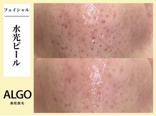 アルゴ 飯塚店(ALGO)/水光ピール