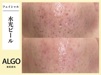 アルゴ 飯塚店(ALGO)/水光ピール