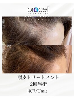 ユミト(Umit)/プロセルスカルプ